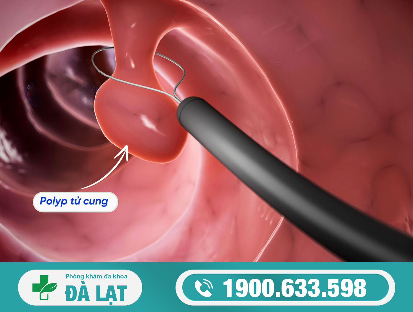 DẤU HIỆU BỊ POLYP CỔ TỬ CUNG - CÁCH ĐIỀU TRỊ HIỆU QUẢ NHẤT? 